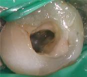 Root Canal and Cancer