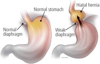 Acid reflux 